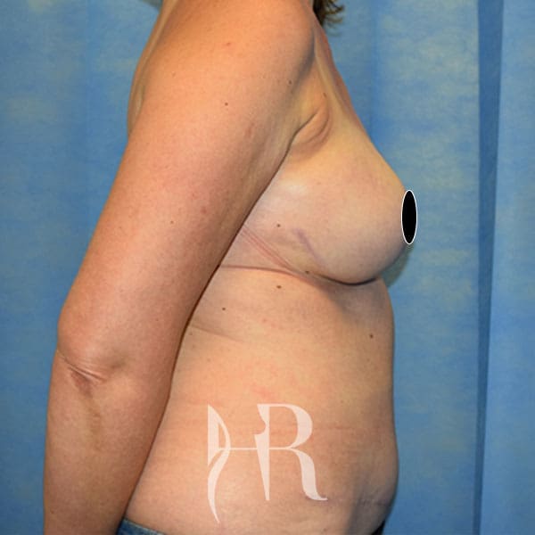 HR Plastic Surgery - Breast Reconstruction patient after 2